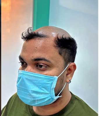 Before treatment