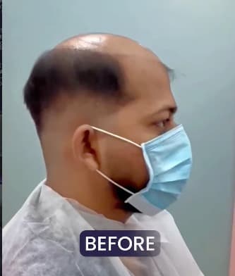 Before treatment